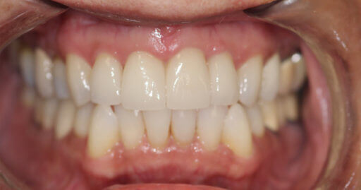 Teeth 1 After