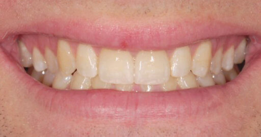 Teeth 2 After