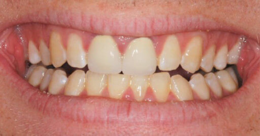 Teeth 2 Before