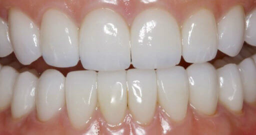 Teeth 3 After