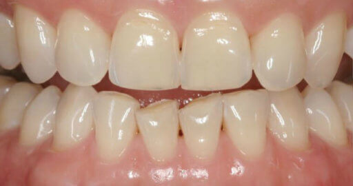 Teeth 3 Before