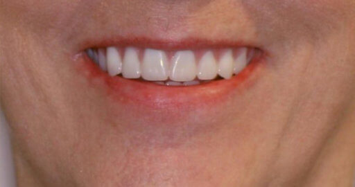 Teeth 4 After