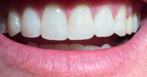 Teeth 5 After