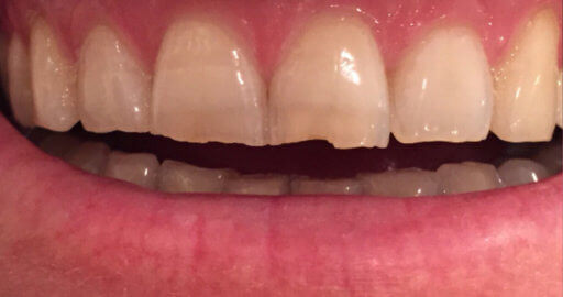 Teeth 5 Before