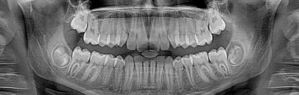 xray teeth