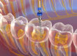 San Diego dentist near me root canal