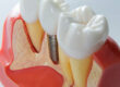 dental implants San Diego